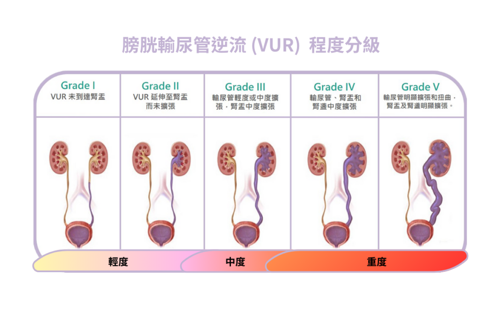 膀胱輸尿管逆流 (VUR) 程度分級