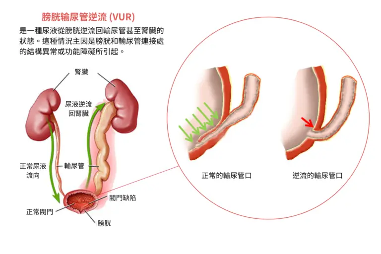 二、什麼是膀胱輸尿管逆流?