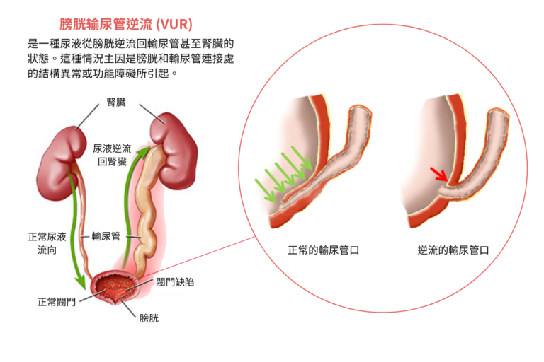 膀胱输尿管逆流 (VUR)是一種尿液從膀胱逆流回輸尿管甚至腎臟的狀態。這種情況主因是膀胱和輸尿管連接處的結構異常或功能障礙所引起。