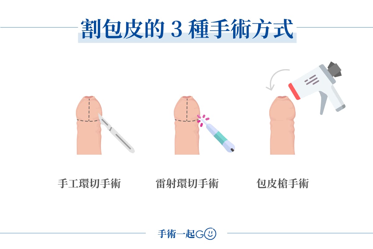 割包皮的 3 種手術方式