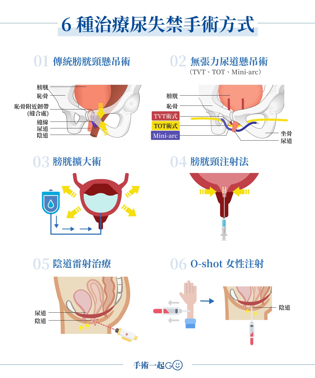 6 種治療尿失禁手術方式