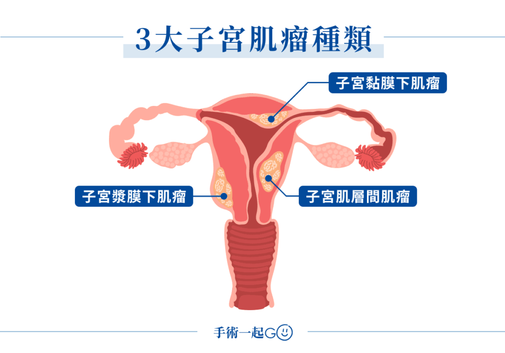 3 大子宮肌瘤種類