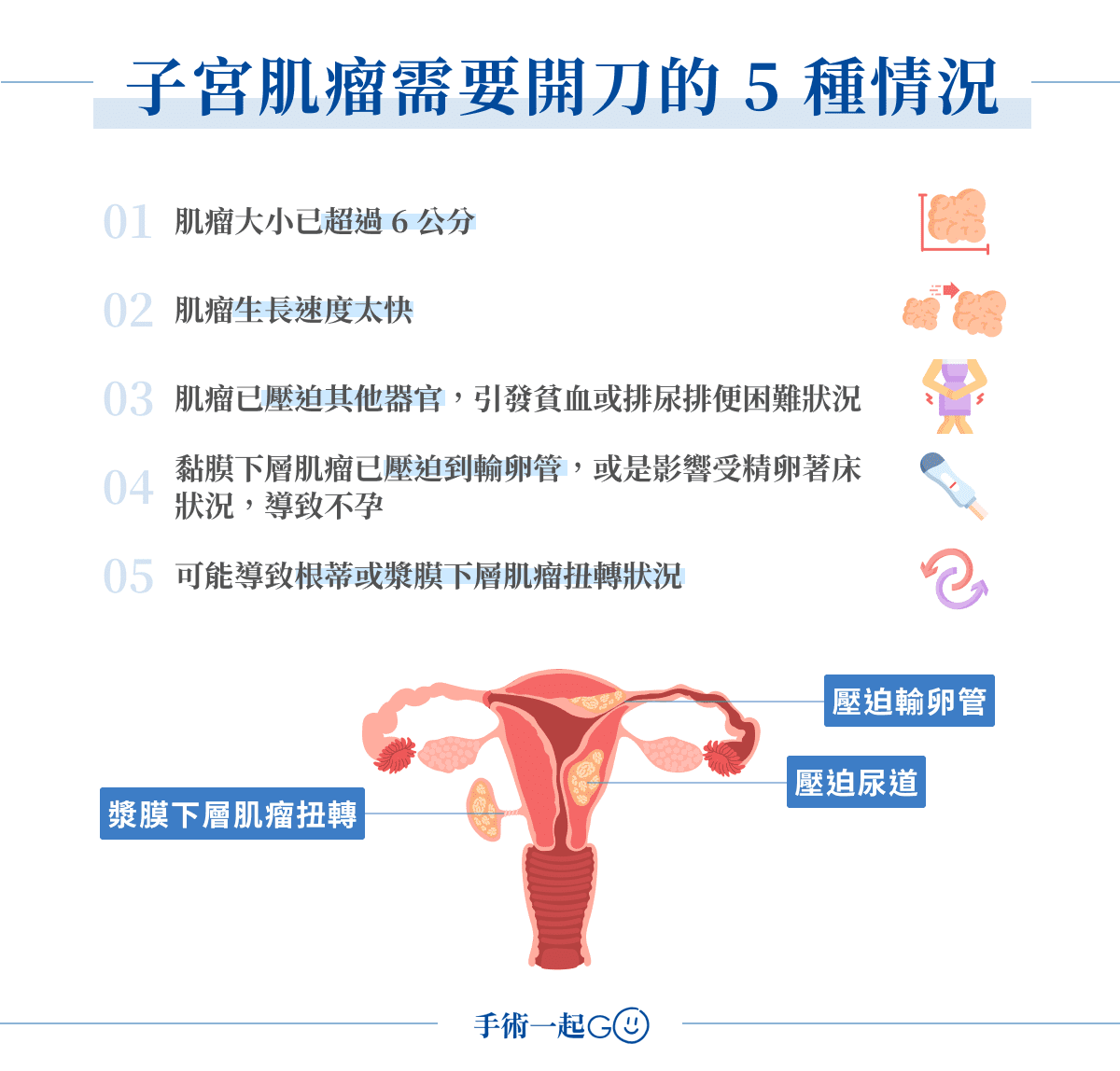 子宮肌瘤需要開刀的 5 種情況