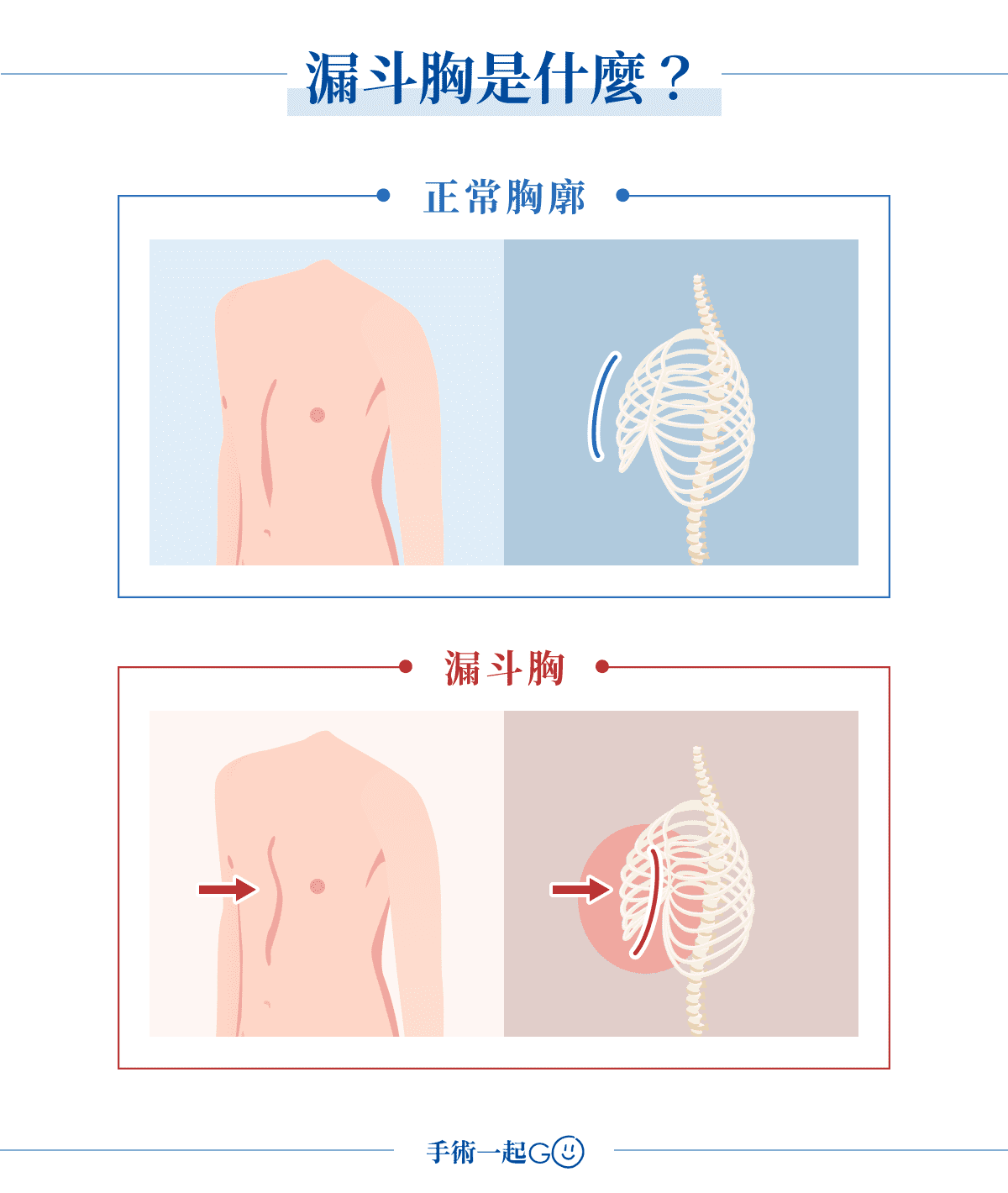 漏斗胸是什麼？