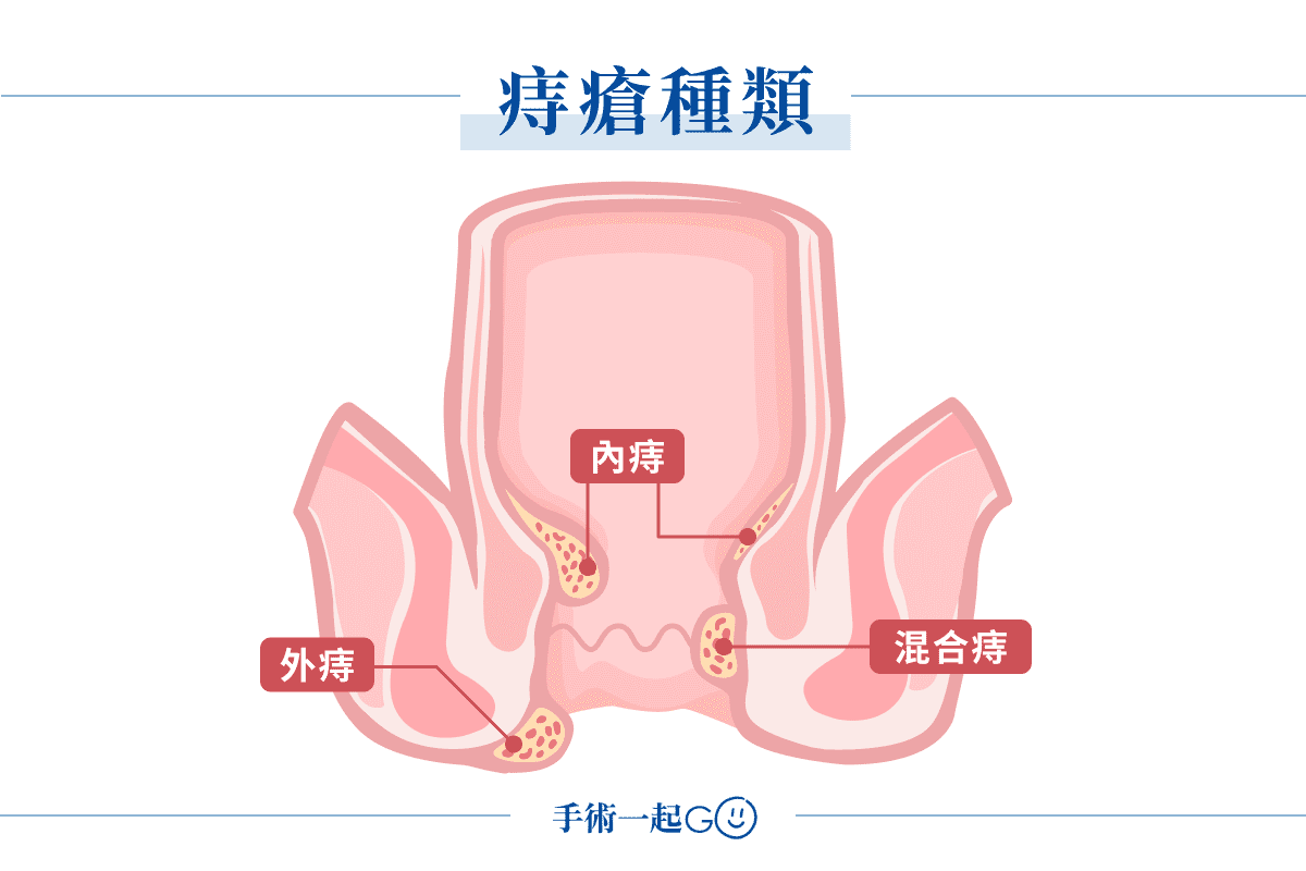 痔瘡種類