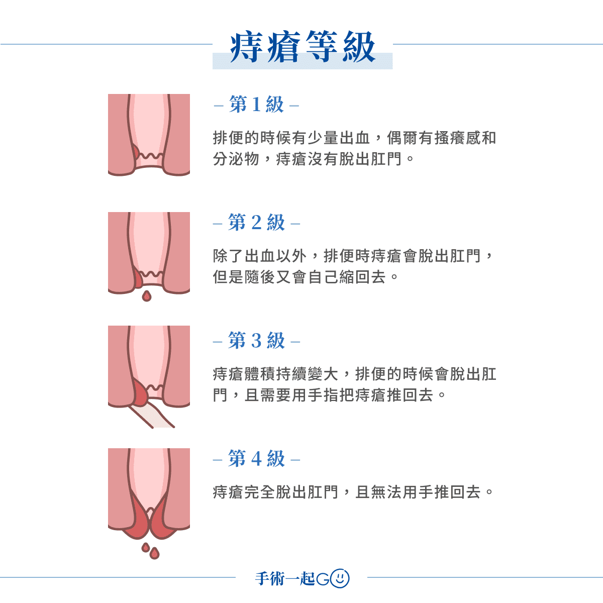 痔瘡嚴重等級