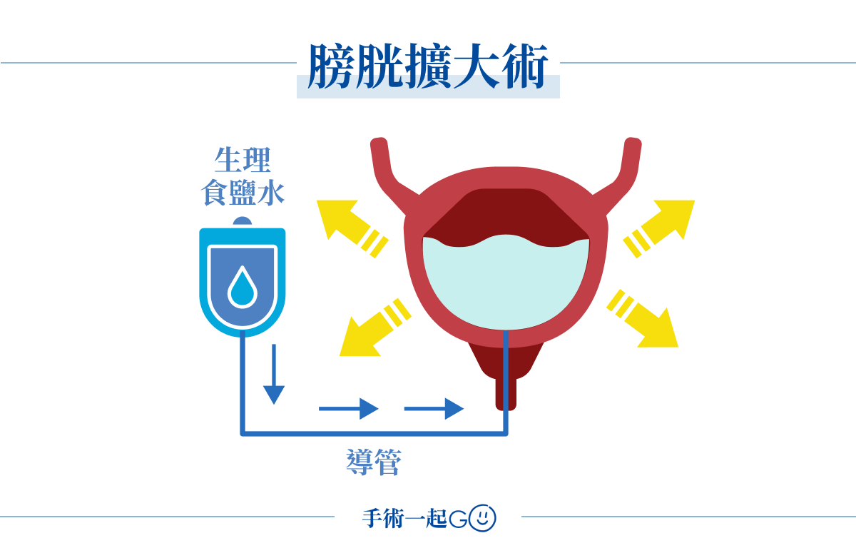 膀胱擴大術