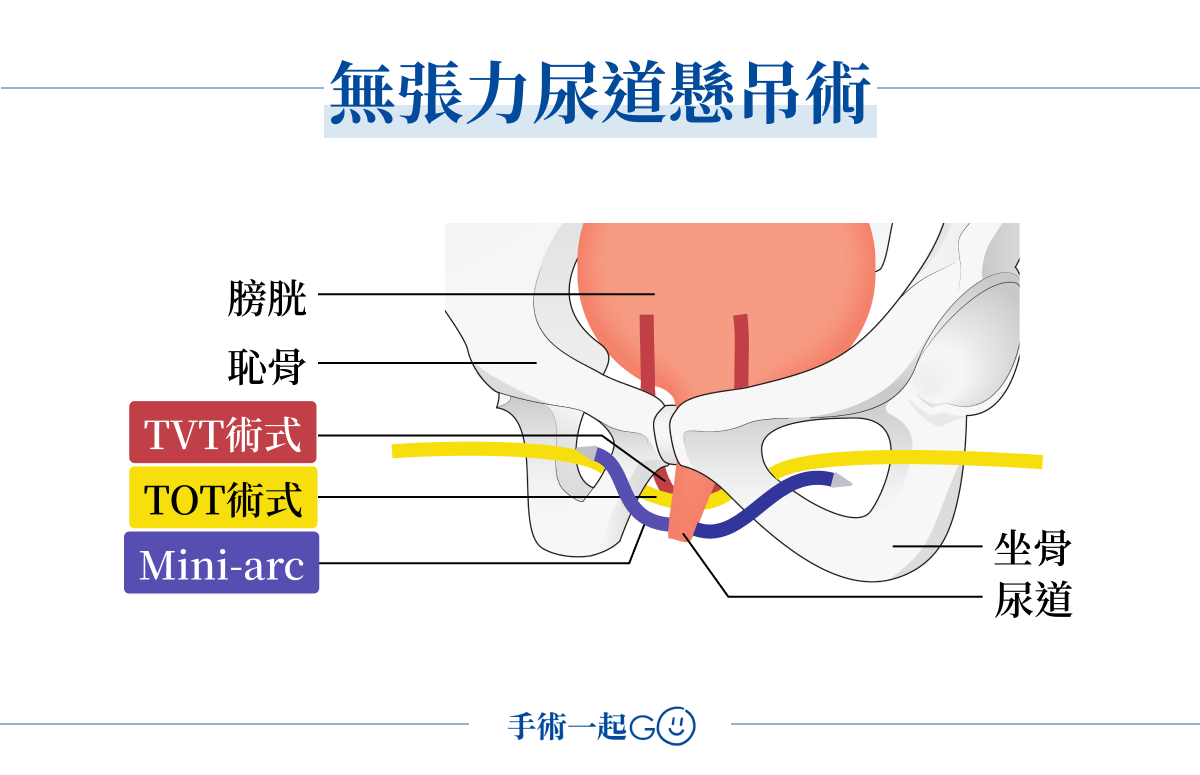 無張力尿道懸吊術