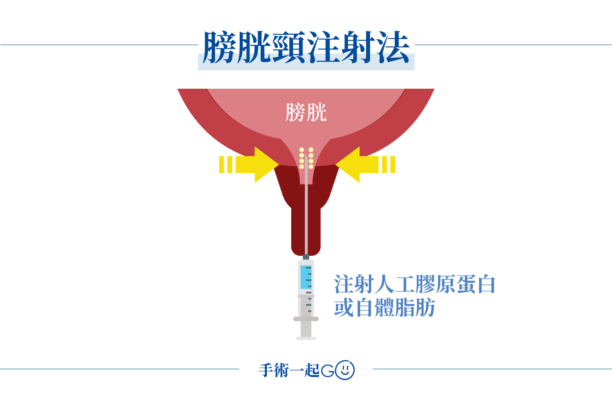 膀胱頸注射法