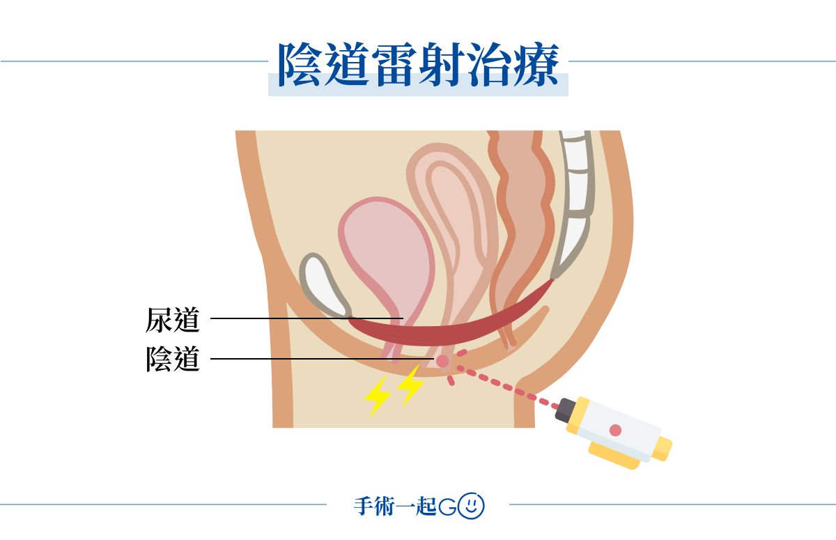 陰道雷射治療