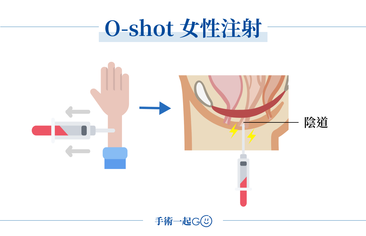 O-shot 女性注射