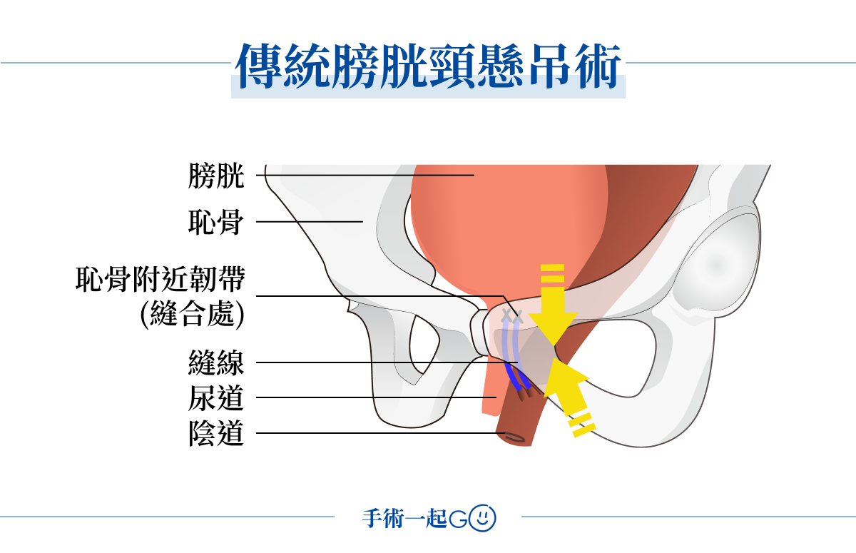 傳統膀胱頸懸吊術