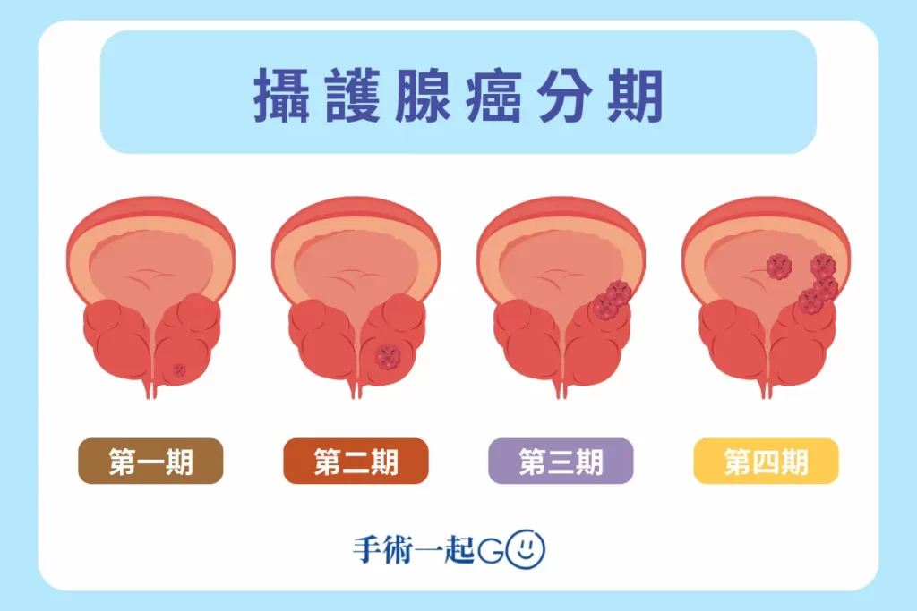 攝護腺癌分期