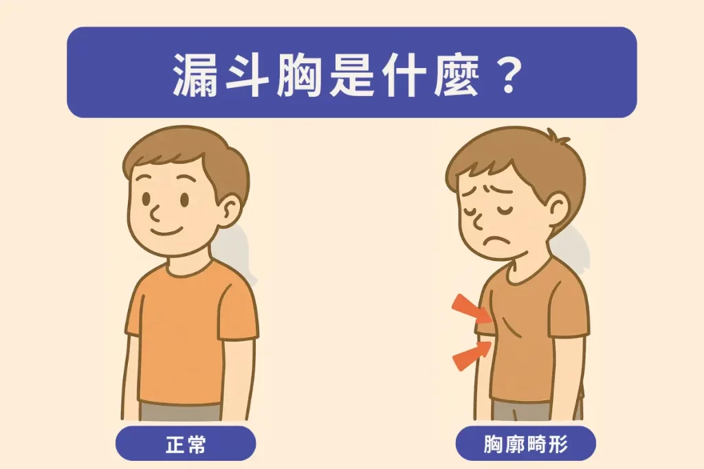 漏斗胸的症狀有哪些?如何發現?