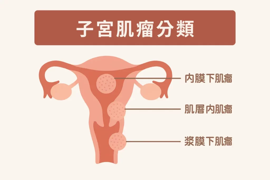 什麼是子宮肌瘤?
