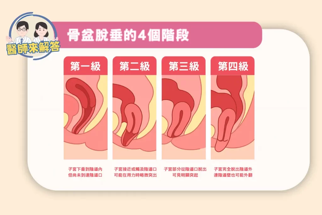 骨盆腔脫垂依嚴重程度分為四個不同的階段